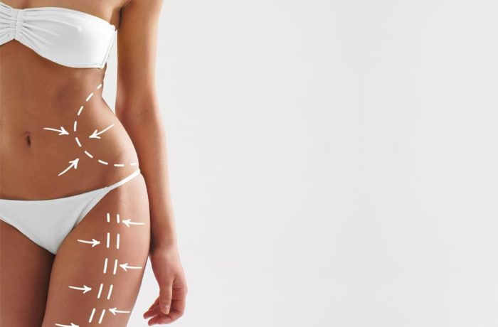 Liposuzione e liposcultura