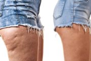 Cellulite, adiposità localizzate