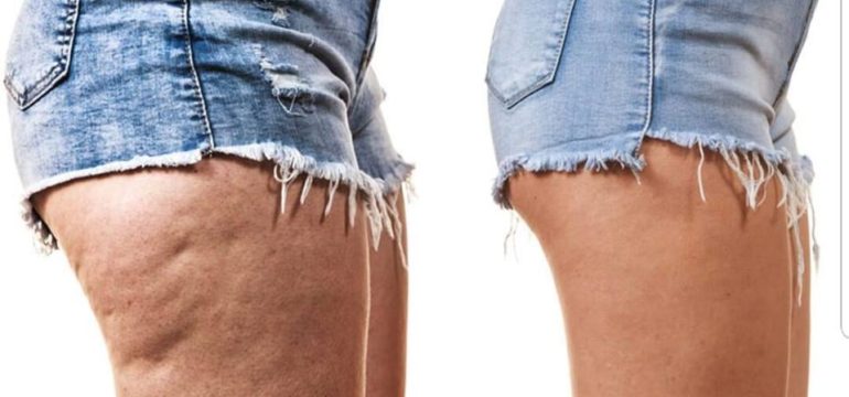 Cellulite, adiposità localizzate