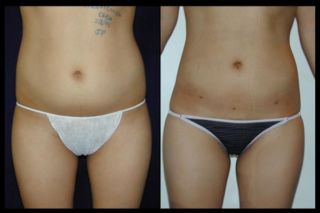 intervento Liposcultura