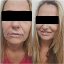 Botox, correzione codice a barre
