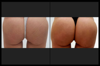 Prima e dopo intervento Glutei